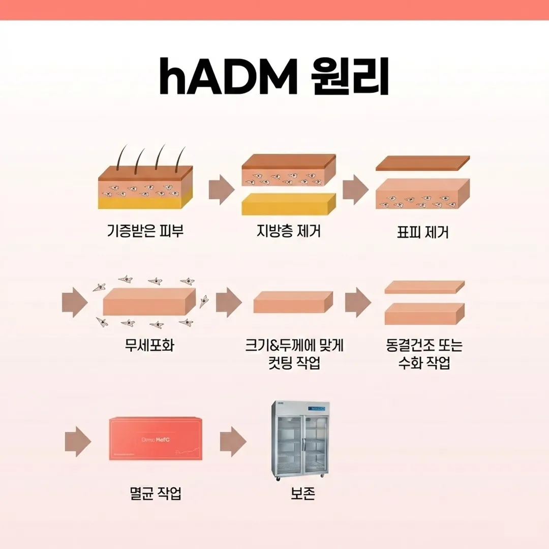 리투오 원리 hADM.webp