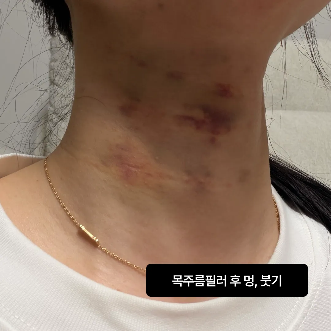 목주름필러 멍 붓기.webp