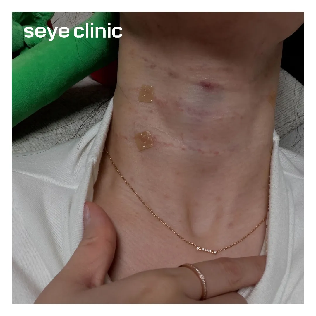 목주름필러 멍.webp