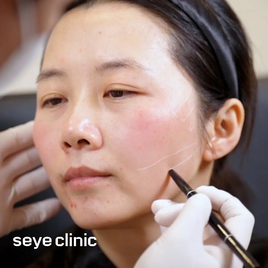 실리프팅 전후.webp