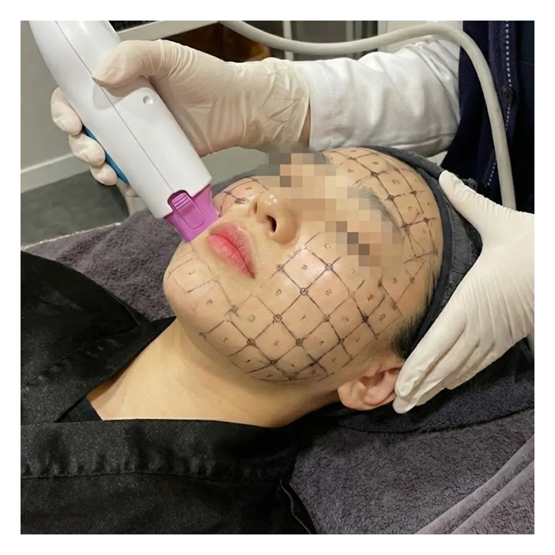 써마지 600샷 후기.webp