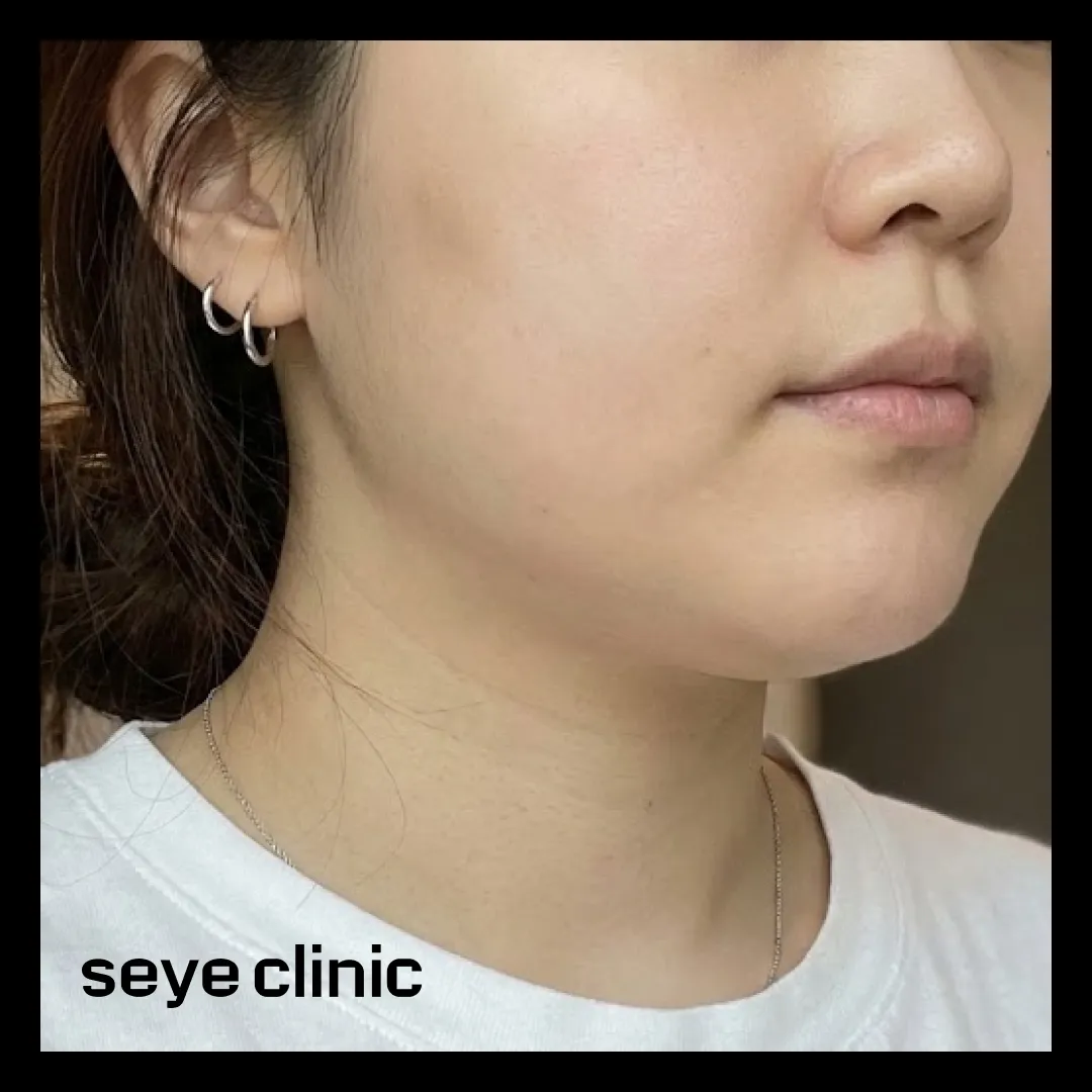 올타이트 400샷 이중턱.webp