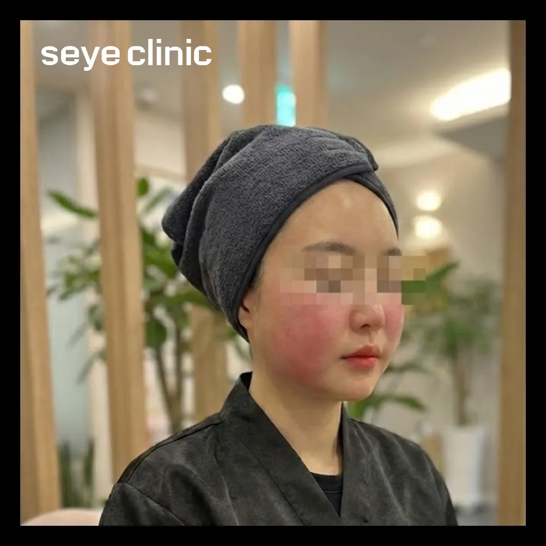 울써마지 붓기 멍.webp