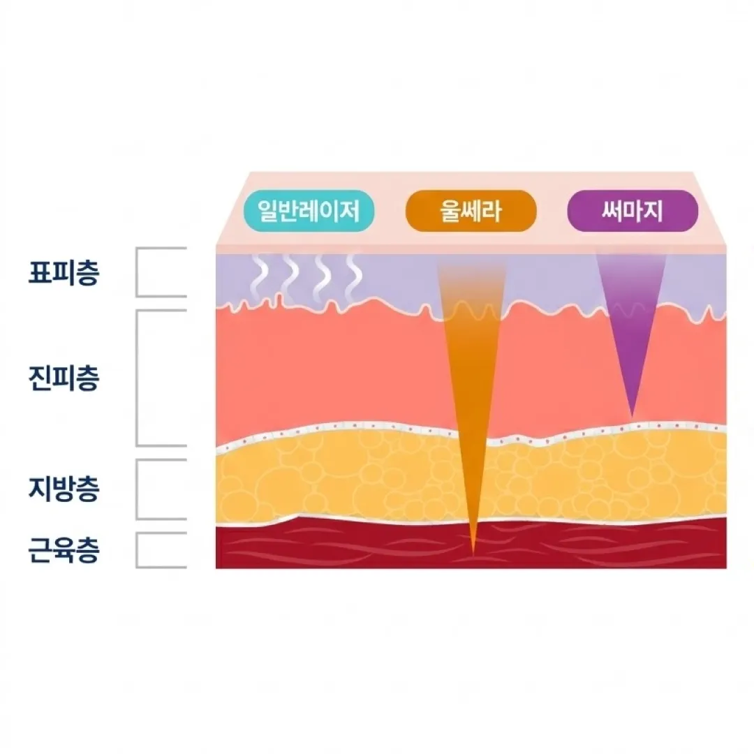 울쎄라 써마지 차이.webp