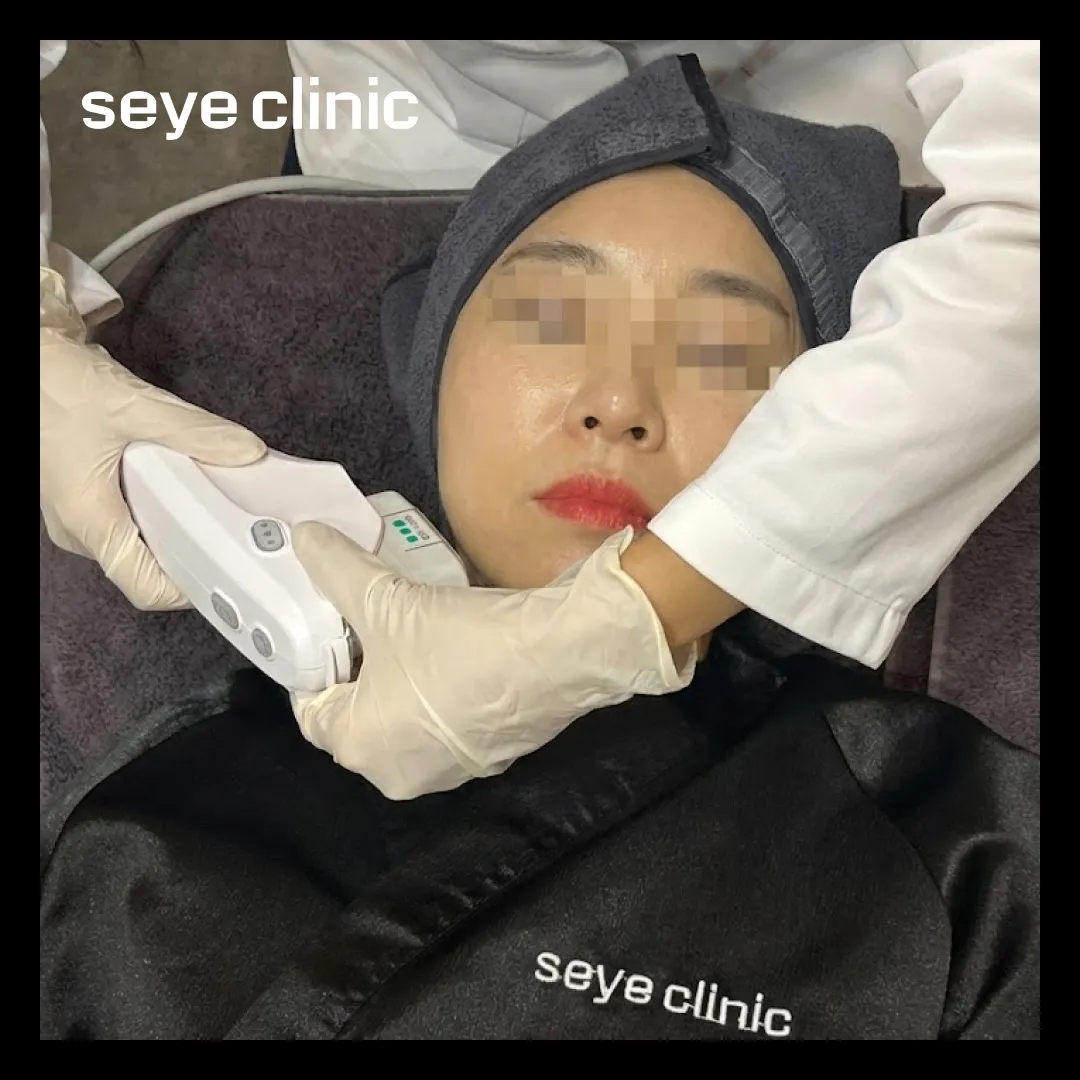 울쎄라 효과 후기.webp