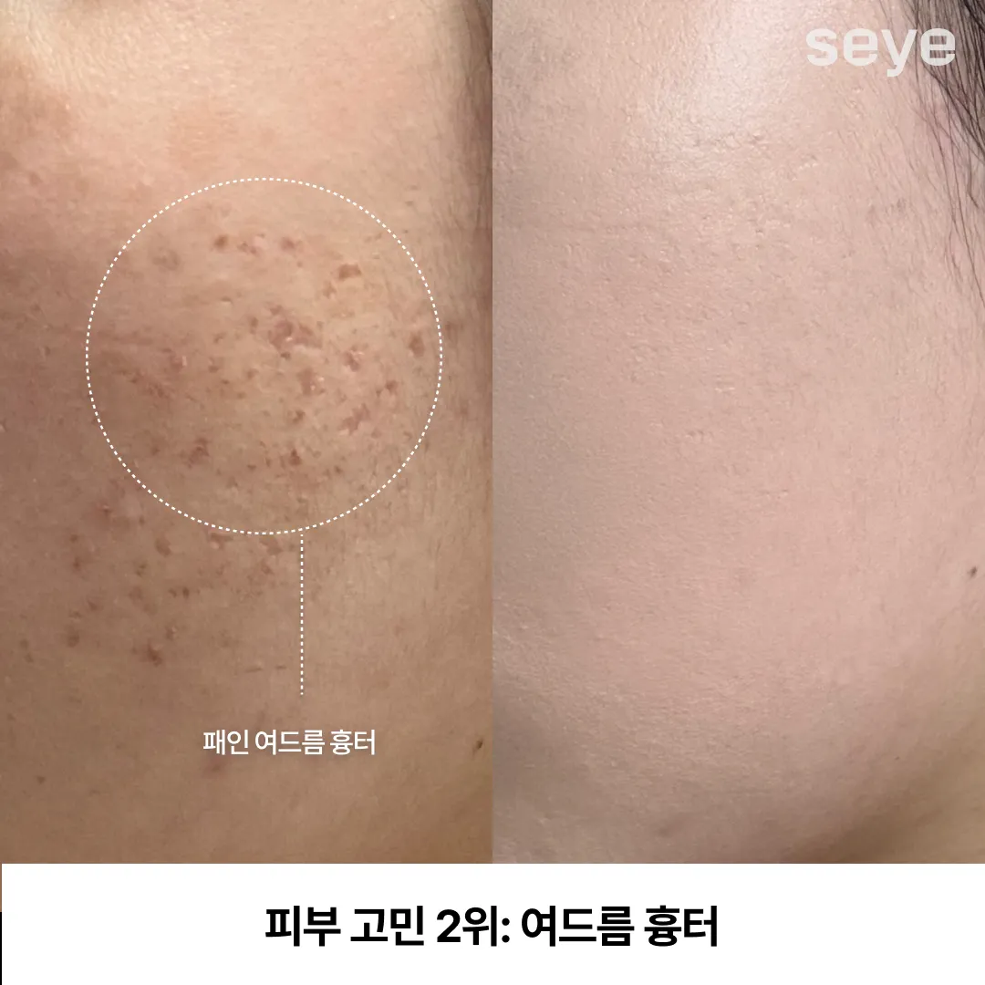 피부 고민 여드름 흉터.webp